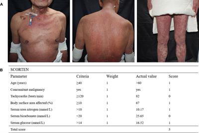 Case Report: Cadonilimab-related toxic epidermal necrolysis-like reactions successfully treated with supplemental Adalimumab